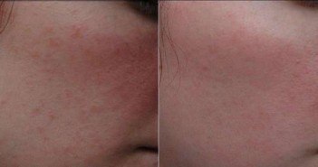 Tout savoir sur le peeling doux (ou léger) du visage ou du cou