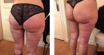 Traitement cellulite lipocavitation