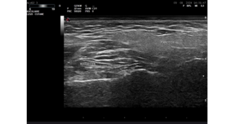 Échographie de la parotide et muscle masseter