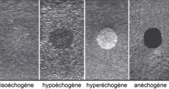 Types d’échogénicité