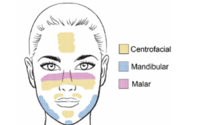 Mélasma sur visage